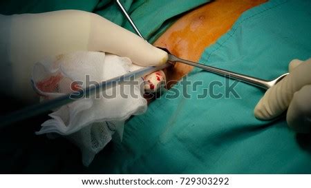 Tube thoracostomy  tube thoracostomy is the insertion of a tube (chest tube) into the pleural cavity to drain air blood bile pus or other fluid  but the tube can also be used to instill medications for pleurodesis. Chest Tube Insertion Pediatric Patient Step Stock Photo ...