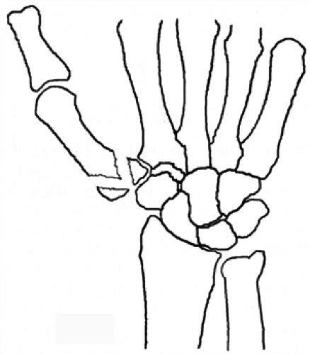 Carpal Metacarpal Fractures And Dislocations Musculoskeletal Key