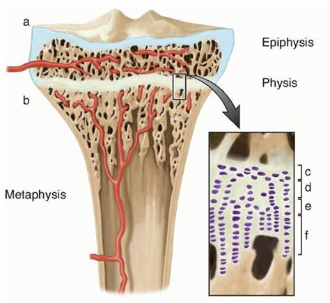 Excision Of Physeal Bar Musculoskeletal Key