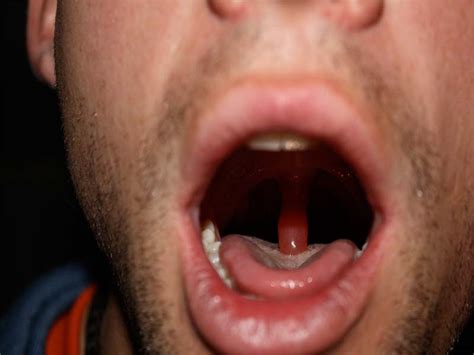Swollen Uvula Sore Throat Causes Treatments And Remedies Aimdelicious