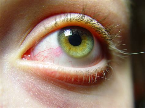 Severe Dry Eye La Jolla Optiks Dr Colin Bernstein Od