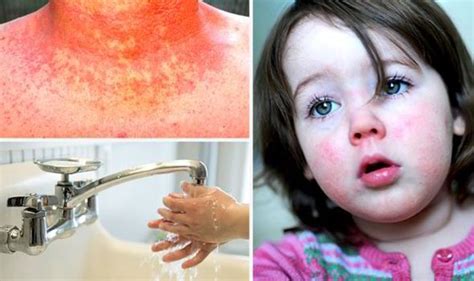 Is A Devastating New Strain Of Scarlet Fever Behind A Huge Rise In The