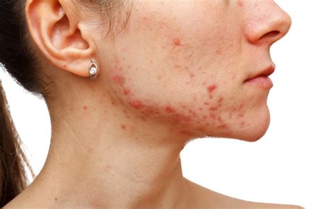 How To Get Rid Of Stubborn Adult Acne Life Support