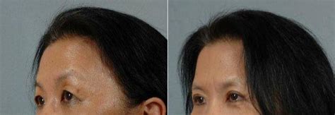 48 Year Old Woman Treated With Asian Eyelid Surgery With Dr Suzanne