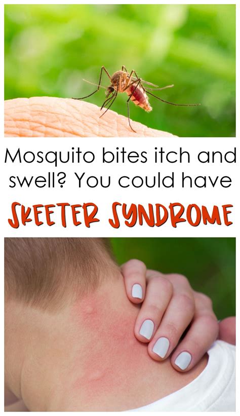 Mosquito Like Bites All Over Body Itchy Bumps On Skin Like Mosquito