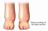 Pictures of Home Remedies For Oedema Legs