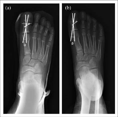 A Plain Radiograph Showing Postoperative Correction Of Valgus Deformity