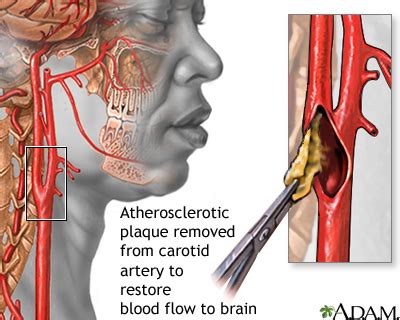 The carotid arteries are the main blood vessels that supply the head and neck. Endarterectomy: MedlinePlus Medical Encyclopedia Image