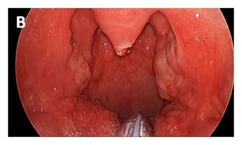 A Telescopic View Of The Pharynx Reveals A Pedunculated Lesion