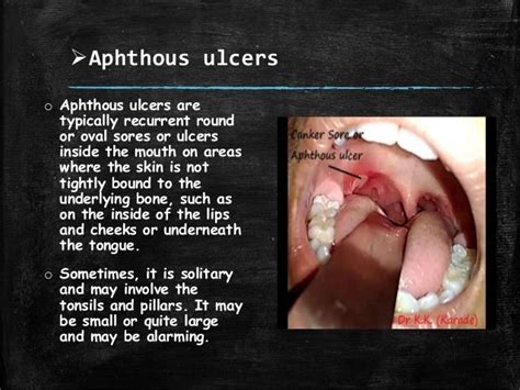 White Patch On The Tonsil Differential Diagnosis