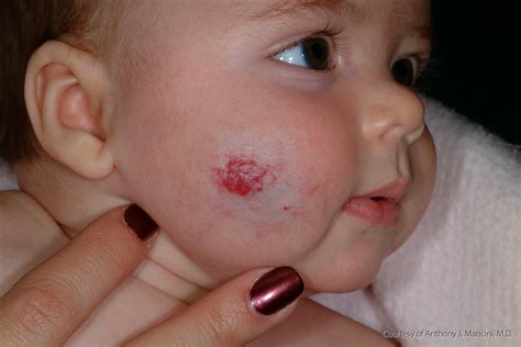 Hemangioma Causes Identification And Diagnosis Wiki Itchy Mind