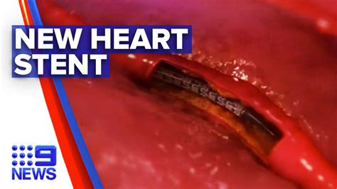 Heart Stent Breakthrough Pumps New Life For Patients Nine News