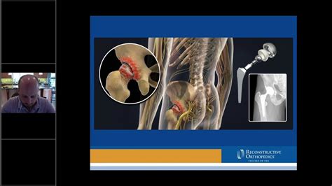 Outpatient Hipknee Replacements Youtube