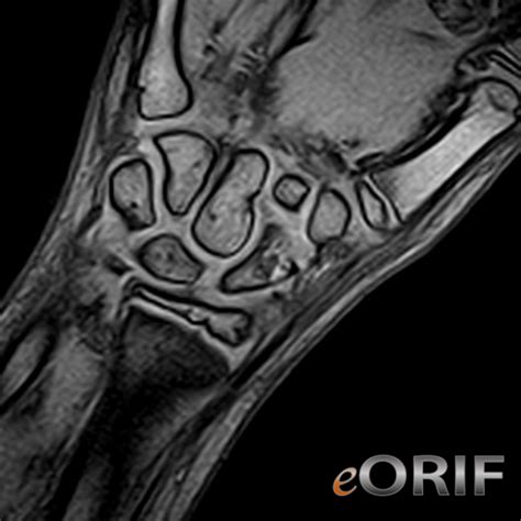Pediatric Scaphoid Fracture | eORIF