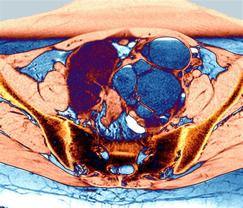 Endometriosis And Ovarian Cyst Photograph By Zephyrscience Photo