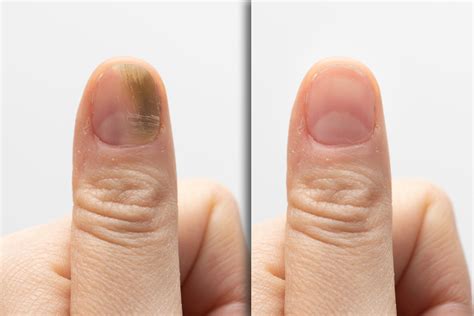2 Natural Remedies To Get Rid Of Nail Fungus Fast Beauty And Healthy Tips