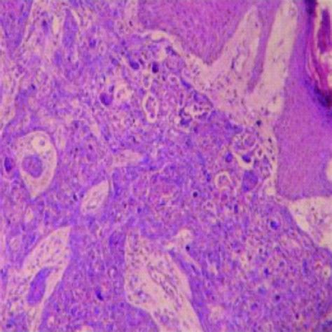 Metastatic Squamous Cell Carcinoma Large Cell Keratinizing Hande Mg X40
