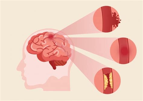 Qué es un accidente cerebrovascular y cuáles son los síntomas FMDOS