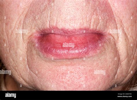 Angioedema Of The Lower Lip Of A 73 Year Old Woman With Urticaria The