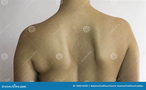 Scoliosis Curved Naked Back Of A Caucasian Woman With Scar Of Spinal Surgery Health Content