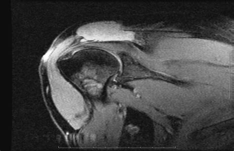 T2 Fat Suppressed Mri Of The Right Shoulder Revealing An Expansile
