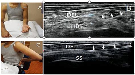 Frontiers The Effectiveness Of Ultrasound Guided Subacromial