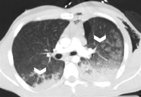 Pulmonary Trauma The Operative Review Of Surgery