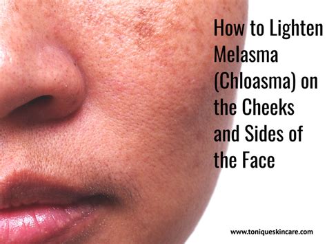 How To Lighten Melasma Chloasma On The Cheeks And Sides Of The Face