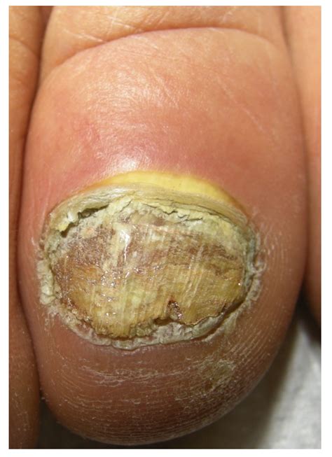 Jof Free Full Text Onychomycosis A Review Html