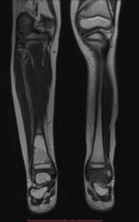 Bone Cyst Image