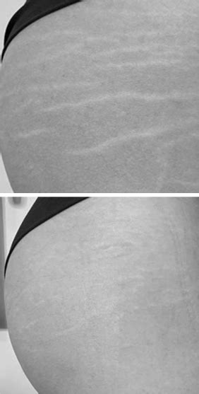 Stretch Mark Camouflage Training Flirt Brows And Beauty Studios