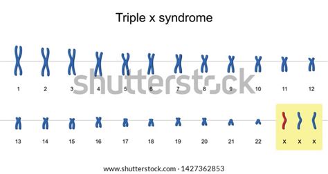 Triple X Syndrome Karyotype Nondisjunction Sex Stock Vector Royalty Free 1427362853