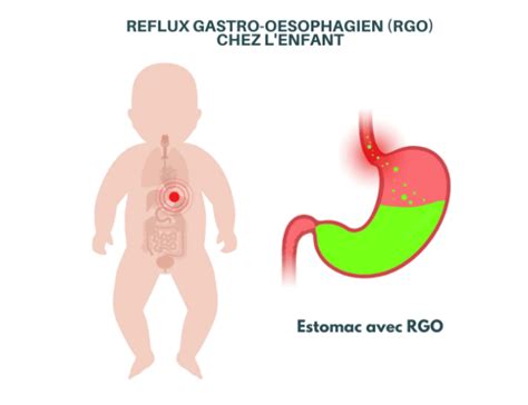 Le Reflux Gastro Oesophagien Pathologique Rgo Lesprosdelapetiteenfance My Xxx Hot Girl
