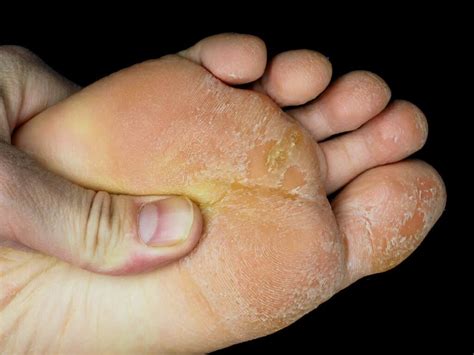 Why Your Feet And Toes Are Peeling Own Harmony