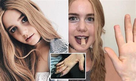Melbourne Woman Gets Prosthetic Fingers After Necrosis Daily Mail Online