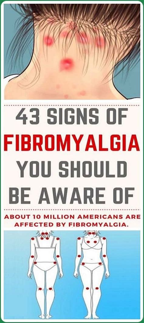 43 Signs Of Fibromyalgia You Should Be Aware Of Heatlhy Nation 201