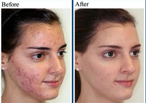 Acne Vulgaris Treatment How To Cure It Fast And Permanently Acne