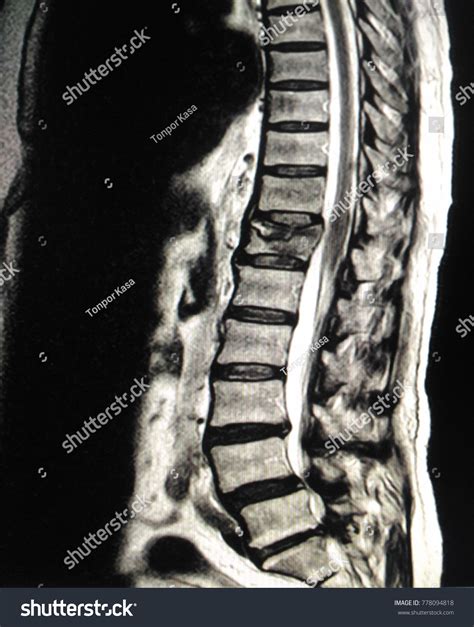 Photo De Stock Mri Thoracolumbar Spinemoderate Compression Fracture T