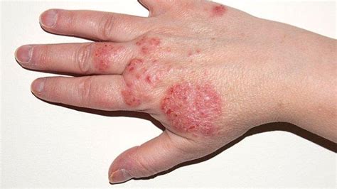 What Is Eczema Inflammatory Conditions On The Skin That Cause Itching World Today News