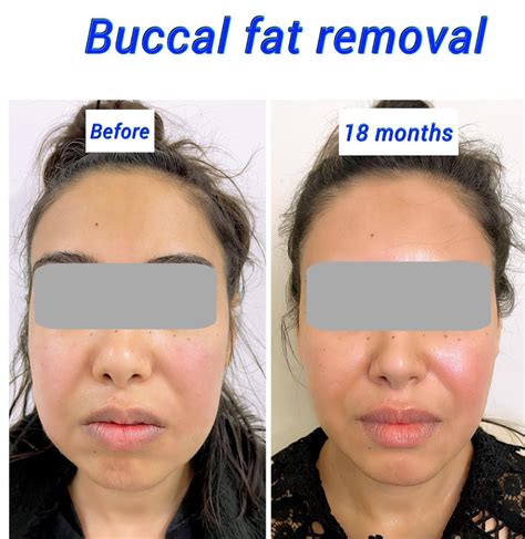 Buccal Fat Pad Removal Harley Clinic