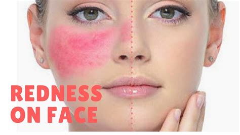 The Best How Remove Redness From Face Ideas