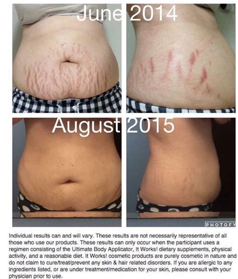 Weight Loss Stretch Marks Xppastor