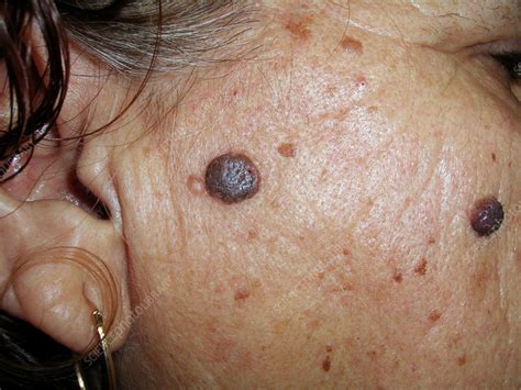 Seborrheic Keratoses Stock Image C0565192 Science Photo Library