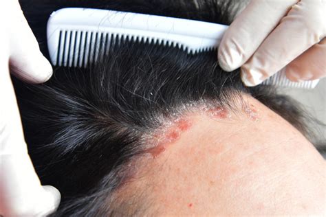 Psoriasis Cheveux Comment Limiter Les Irritations Elithair