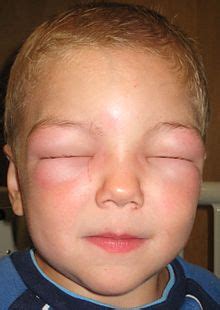 Sometimes they're even painful and feel warm, similar to an infection, says bassett. Skeeter Syndrome Symptoms | Skeeter Syndrome | Mosquito ...
