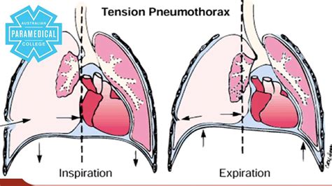 The aim of this study was to identify the risk factors for the development of tension pneumothorax and its effect on clinical outcomes. Paramedics Course - Tension Pneumothorax - Australian ...