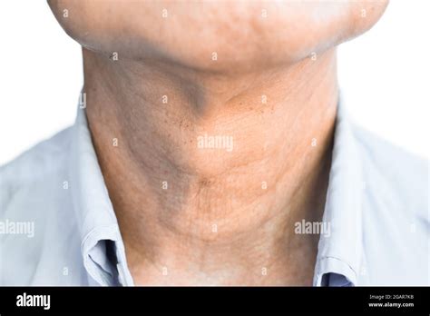 Goiter Neck Hi Res Stock Photography And Images Alamy