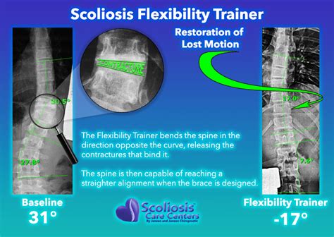 Silicon Valley Scoliosis Back Brace Scoliosis Care Centers