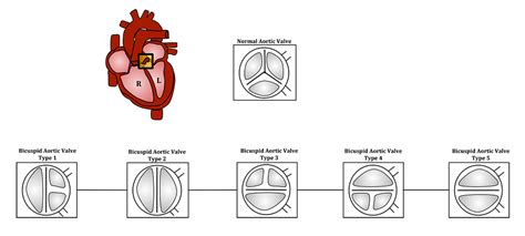 Bicuspid Aortic Valve Heart Valve Disease Bicuspid Aortic Valve My Xxx Hot Girl