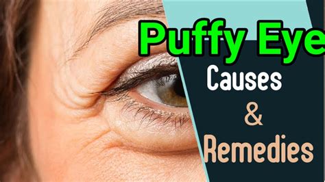Puffy Eyes Causes And Home Remedies Youtube
